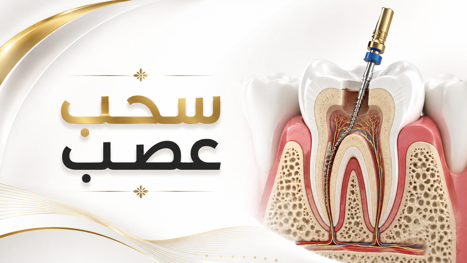 سحب عصب وعلاج جذور